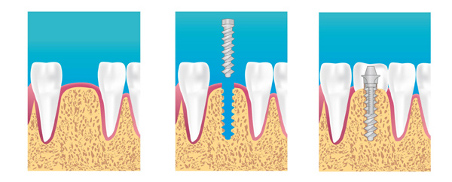 implants dentaires Toulon Dentego