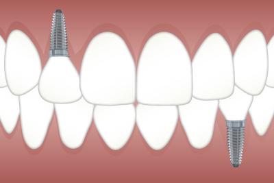 implant centre dentaire toulon